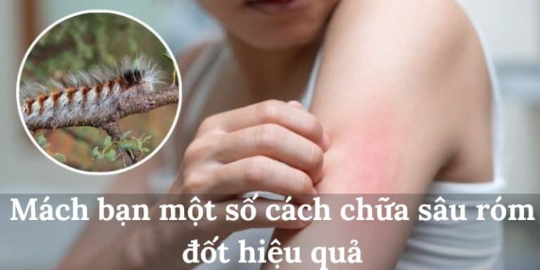 Sâu róm đốt