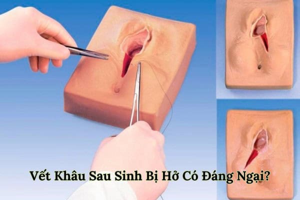 Vết