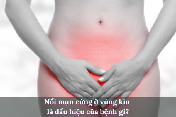 Mụn